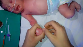 تركيب كانيولا للاطفال IV cannula insertion for baby [upl. by Tenneb]