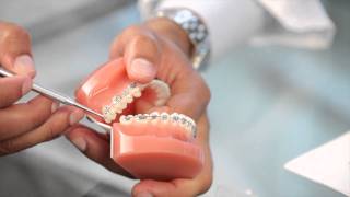 Braces Broken Bracket Poking Wire Braces Pain  Aura Orthodontics [upl. by Boylan]