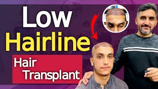 Low Hairline Hair Transplant [upl. by Fabron]