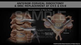 Anterior Cervical Discectomy amp Disc Replacement at C45 amp C56 [upl. by Essyle183]