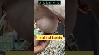 Umbilical hernia l Dr Umar Khan [upl. by Tyra801]