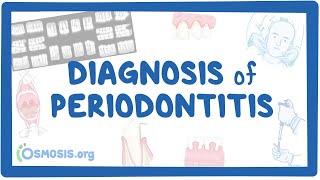 Diagnosis of Periodontitis [upl. by Lunna]