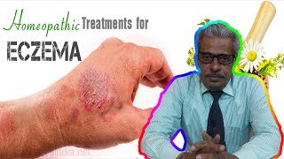 Eczema Dermatitis Treatment in Homeopathy by Dr PS Tiwari [upl. by Ikeda]