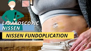 Nissen Fundoplication What Is It Procedure Details amp [upl. by Meekar]