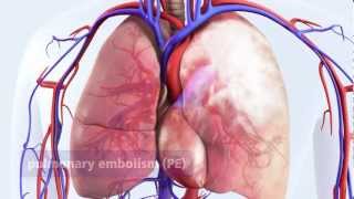 DVT can lead to pulmonary embolism PE [upl. by Jenna608]