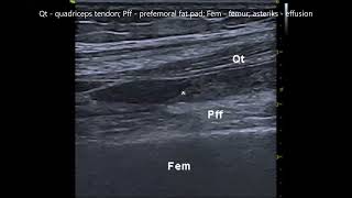 Suprapatellar recess effusion [upl. by Aloap]