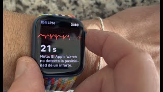 AFib Atrial Fibrillation EKGECG on Apple Watch [upl. by Elyrpa]