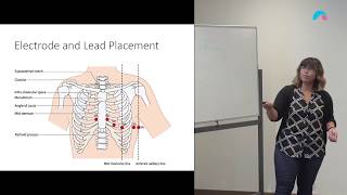 12 Lead ECG Placement  Clavicular Method v Angle of Louis  Ausmed [upl. by Morganne636]