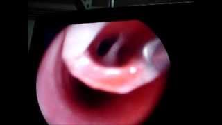 Bronchoscopy Rigid for Foreign body Whistle [upl. by Ahsenal687]