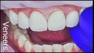 how each one is cemented in place emax veneers [upl. by Buyers436]