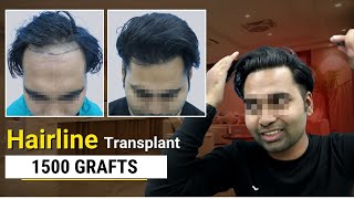 Hairline Transplant  Hairline Transplant in India  FUE Hair Transplant  FUE  Satya Clinic [upl. by Nedearb587]