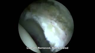 Hip Labral Reconstruction [upl. by Damita]