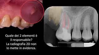 Dente devitalizzato che fa male [upl. by Weinberg]