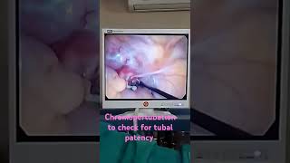 laparoscopic chromopertubation for checking tubal patencyhealthmedicalinfertility tube block [upl. by Shirline634]