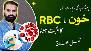 Blood in Urine or High RBCs in Urine Test Causes Symptoms amp Treatment [upl. by Akemal]