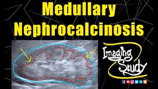 Medullary Nephrocalcinosis  Ultrasound  Case 128 [upl. by Anallise]