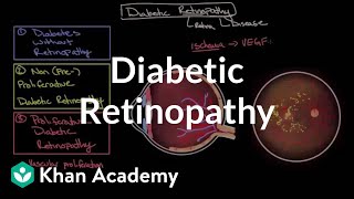 Diabetic retinopathy  Endocrine system diseases  NCLEXRN  Khan Academy [upl. by Bidle428]