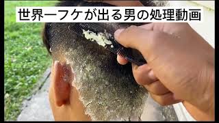 世界一フケが出る男のディープクリーニング動画 dandruff video treatment [upl. by Lula616]