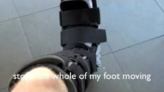 Stress Fracture 2nd Metatarsal [upl. by Elletnuahc]