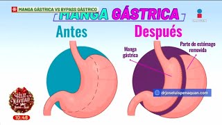 DIFERENCIA entre Manga gástrica y el Bypass gástrico El cirujano José Luis Peña Quan nos explica [upl. by Miko428]