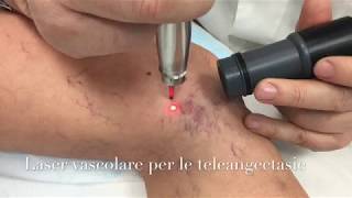 Laser vascolare per i capillari delle gambe [upl. by Jacques98]