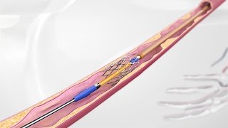 3D Medical Animation Vascular Stent System for Leg Arteries [upl. by Alfie249]