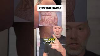 Stretch Mark Formation and Treatment [upl. by Bilac]