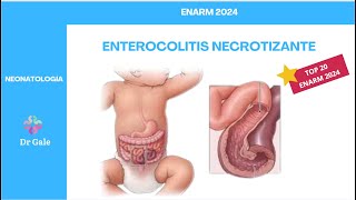 NEONATOLOGÍA  ENTEROCOLITIS NECROTIZANTE  ENARM 2024 [upl. by Enicar698]