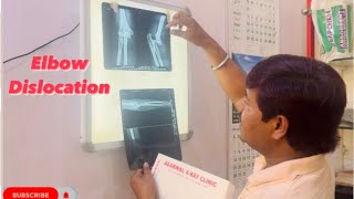 Elbow dislocation amp reduction pain relief by Rakesh pahalwan jai bhagwan tharepy centre Chiropractor [upl. by Gerry]