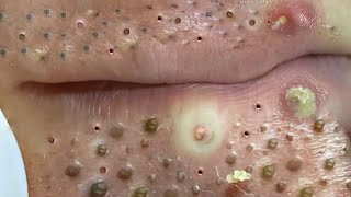 Big Cystic Acne Blackheads Extraction Blackheads amp Milia Whiteheads Removal Pimple Popping  203 [upl. by Sirmons784]