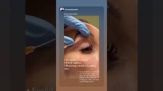 Expert Eyelid Rejuvenation with Advanced Fillers at EDEN AESTHETICS Dubai [upl. by Britni755]