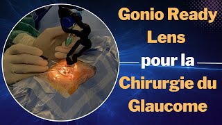 Explorant le Gonio Ready Lens pour la Chirurgie du Glaucome [upl. by Klecka]