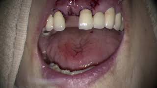 Frenectomy after Straumann implant placement [upl. by Valry315]