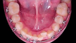 Braces process transformation [upl. by Nirtak]