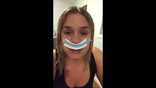 Septoplasty and Turbinate Reduction [upl. by Lamont122]