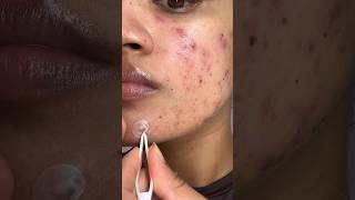 Pimple patch peel off pimplepatch pimplepatches acnepatch acne peeling acnepositivity acnes [upl. by Goldfarb]