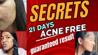 21 Days Acne Removal Challenge Guaranteed Result  Pimple Treatment  Skin Care Products [upl. by Kroll414]