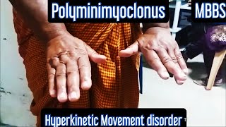 Polyminimyoclonus Hyperkinetic Movement Disorder mbbs medicine neetpg neet aiims usmle [upl. by Nire110]