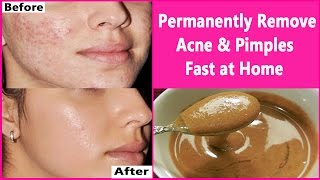 In 3 DAYS Permanently Remove Acne amp Pimples Fast at Home  Overnight Acne amp Pimples Treatment [upl. by Anem]