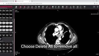 MedDream DICOM Viewer delete measurements [upl. by Onirefes]