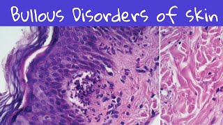 Bullous Disorders of Skin dermatology dermatopathology [upl. by Nomled]