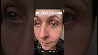 Before amp 4 Days After Trifecta Lift for Eye Bags Crepey Skin and Volume Loss  Beverly Hills CA [upl. by Drisko]