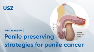 Breaking the Silence Shedding Light on Penile Cancer [upl. by Neelhtak353]