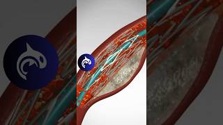 See how an Angioplasty and Stent Placement work in 3D animation [upl. by Hahseram316]