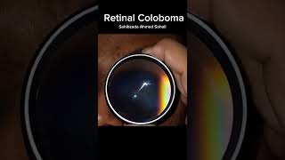 Retinal Coloboma Clinical View Captured with 20D Indirect Lens [upl. by Attenoj333]