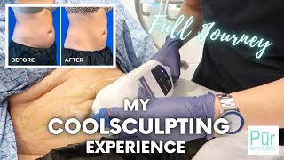 My COOLSCULPTING EXPERIENCE  Full Journey  COOLSCULPTING BEFORE AND AFTER Photos  Pūr Skin Clinic [upl. by Hairahs]