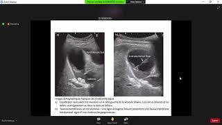 Complications de la Lithiase Vésiculaire  cours externat 2021 [upl. by Azral]