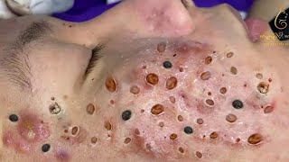 Blackhead Removal With Sac Dep Spa 1000617 [upl. by Ayrotal]