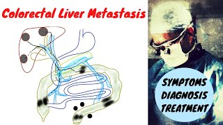 Stage 4 Colon Cancer Liver Metastasis Symptoms Diagnosis Treatment [upl. by Clemente]