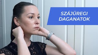 Semmelweis oktatóvideók Szájüregi daganatok – önvizsgálat lépésről lépésre [upl. by Elatnahc]